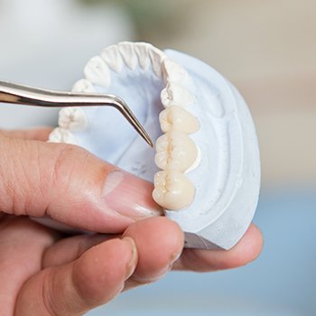 Model smile with dental bridge