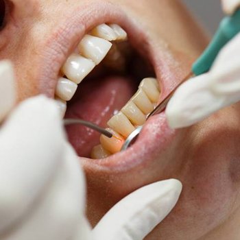 Closeup of patient receiving laser gum disease treatment