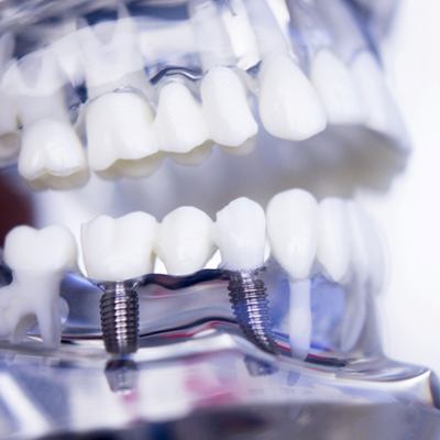 model of implant-retained bridge