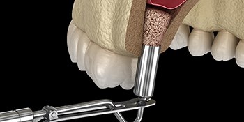 Diagram showing sinus lift in Lehigh Valley