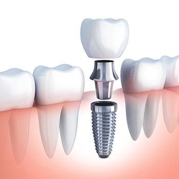 Diagram showing the parts of dental implants in Lehigh Valley