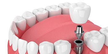 Diagram showing single tooth dental implant in Phillipsburg