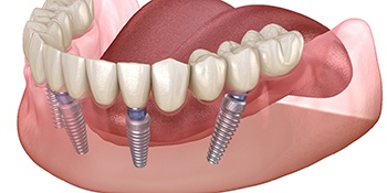 Diagram of an implant denture after placement