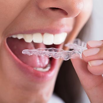 Closeup of patient placing Invisalign tray