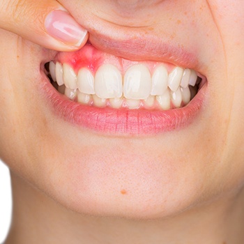 Closeup of damaged gums