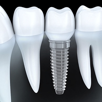 Animation of implant dental crown