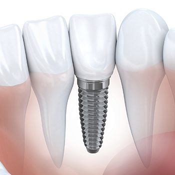 Animation of implant supported dental crown