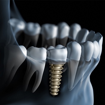 Animation of implant supported dental crown