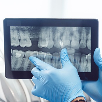 Digital dental x-rays