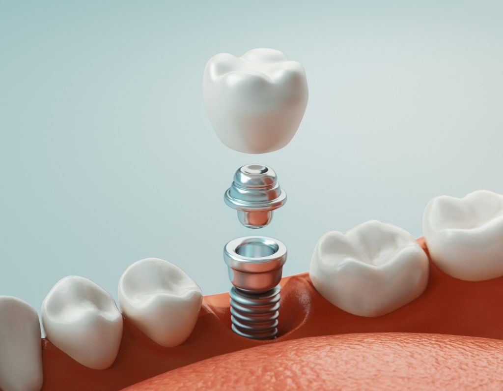Illustration of single dental implant