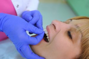 a woman getting veneers placed on her teeth
