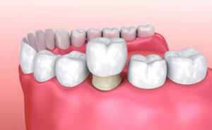 Illustration image of a dental crown halfway over a tooth in front of pink background