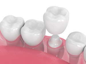 Illustration of metal-free crown placed on tooth