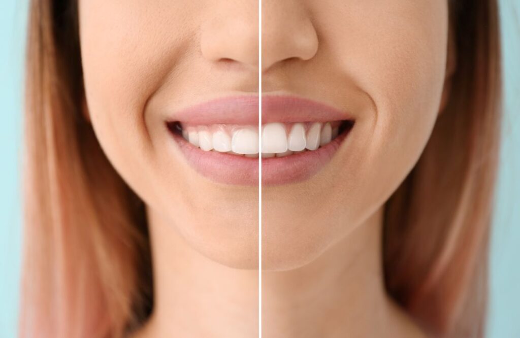 A woman before and after gum contouring treatment.